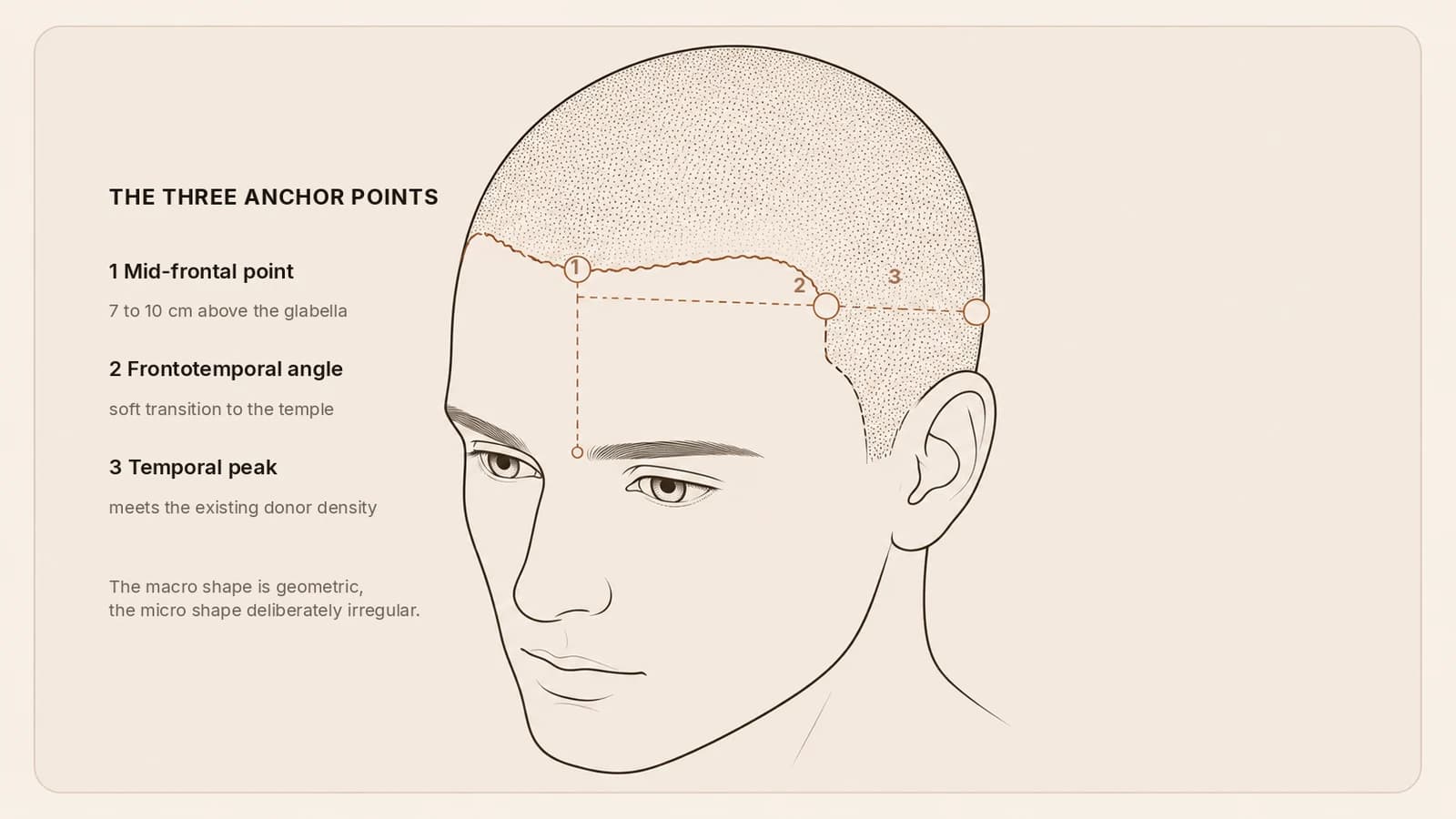 The three anchor points of a natural hairline design