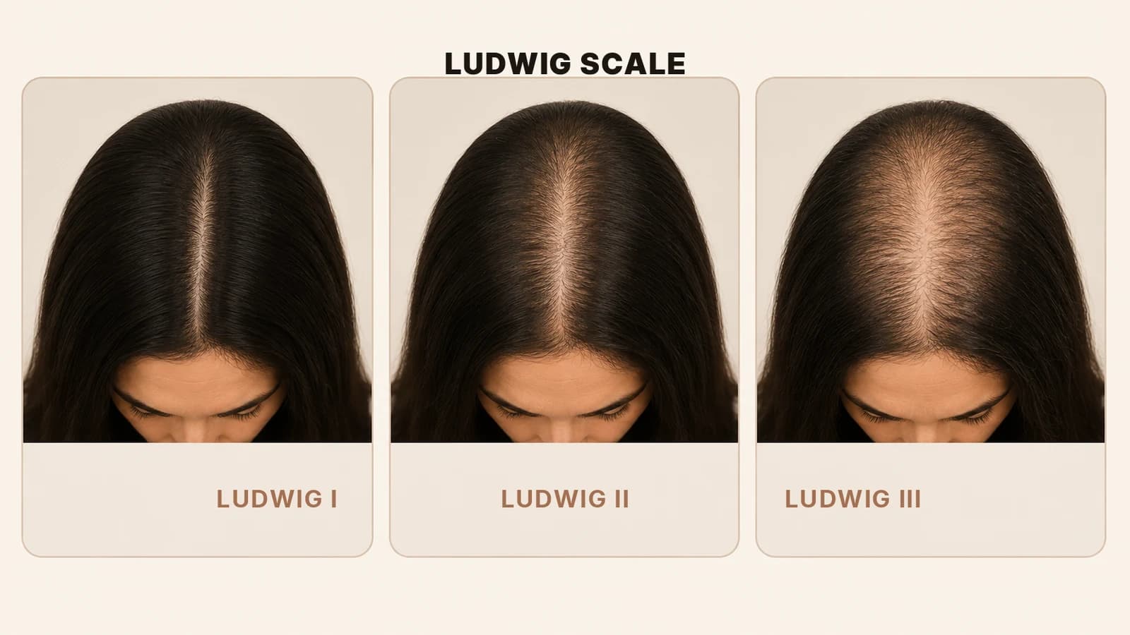 The Ludwig scale showing three stages of female pattern hair loss