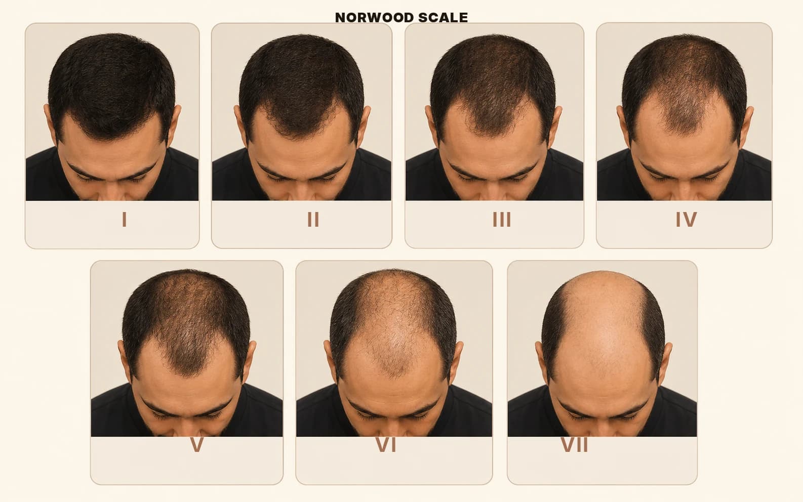 The Norwood scale showing the seven stages of male pattern hair loss