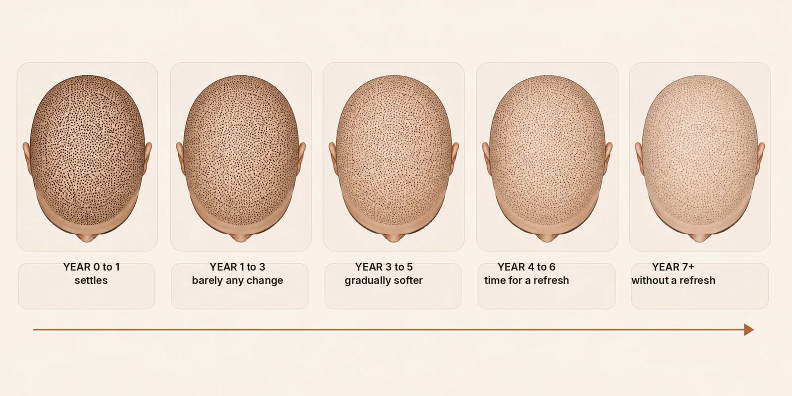 How scalp micropigmentation pigment fades over six years